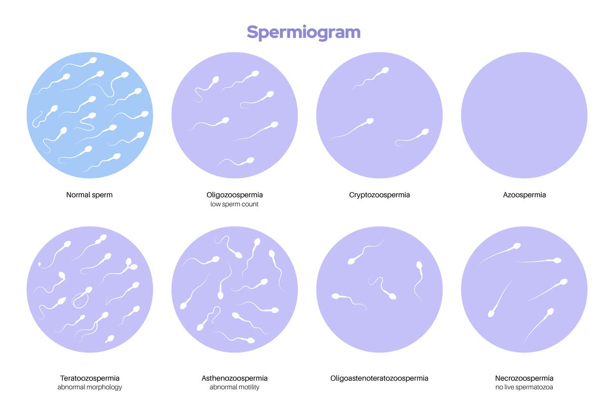 azospermi-nedir